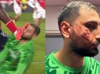 Gianluigi Donnarumma suffers facial trauma after hair-raising kick during Monaco-PSG match